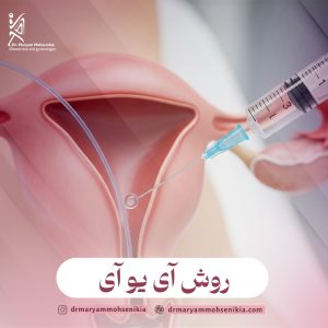 روش آی یو آی