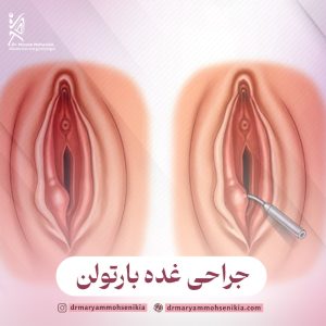 جراحی غده بارتولن