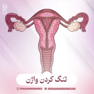تنگ کردن واژن