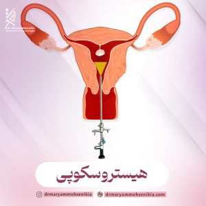 هیستروسکوپی